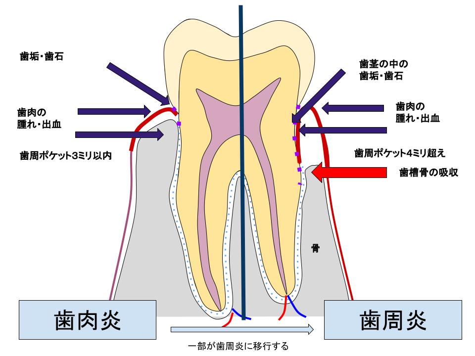 歯肉炎と歯周炎の違い
